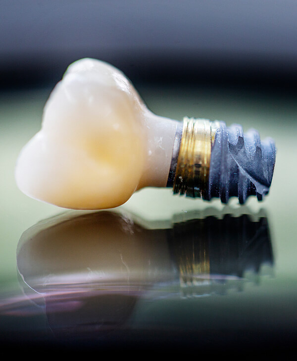 implant zęba
